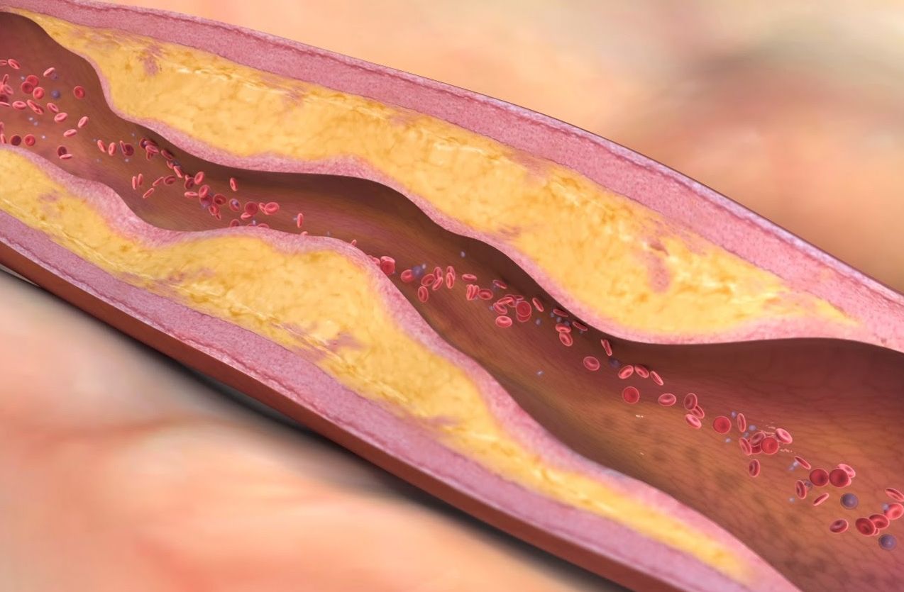 Образование бляшек в сосудах. Атеросклеротическая бляшка.
